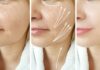 Лифт тканей лица, носогубные складки — как подтянуть?