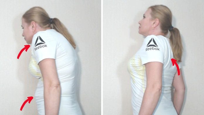 верхний перекрестный синдром