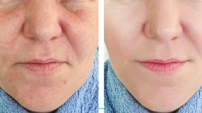 Как подтянуть щеки и носогубки в домашних условиях