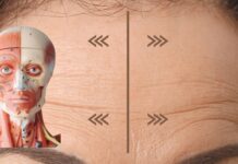 Метопический шов: упражнения от морщин на лбу