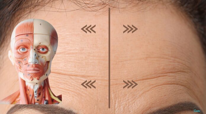 Метопический шов: упражнения от морщин на лбу